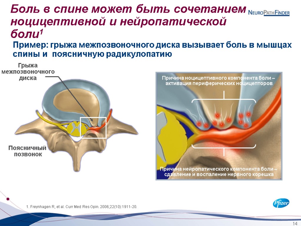 14 Поясничный позвонок 1. Freynhagen R, et al. Curr Med Res Opin. 2006;22(10):1911-20. Пример: